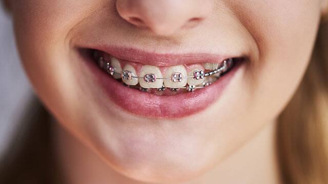Close up of teeth with braces Close up of teeth with braces