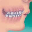 overbite teeth and orthodontics - colgate sg