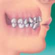 crowding teeth and orthodontics - colgate in