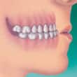 underbite teeth and orthodontics - colgate in