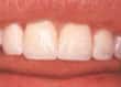 bonded teeth - colgate in