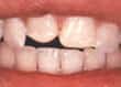 misshapen teeth before bonding - colgate in