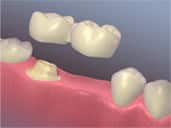 cantilever dental bridge - colgate ph