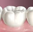 cavities1