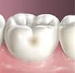 cavities2