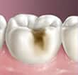 cavities3