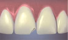 bonding for chipped tooth - colgate ph