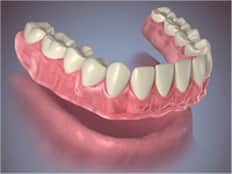 Conventional Full Denture