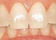 discoloured teeth before whitening - colgate in