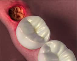 Alveolo seco después de la extracción de la tercera molar (muela del juicio)