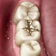 gold dental filling - colgate in