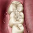 white dental filling - colgate in