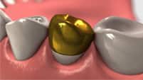 gold alloy crown - colgate in