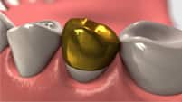 gold alloy crown - colgate ph