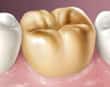 gold crown tooth - colgate in