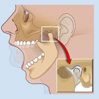 Desorden Temporomandibular