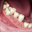 implants and artificial teeth dentures - colgate sg