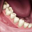 dental implants procedure - colgate in