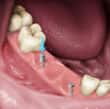 dental post for implants - colgate sg