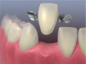 maryland dental bridge - colgate ph