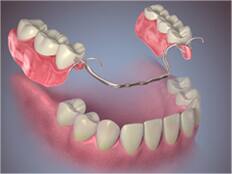 Partial Denture.