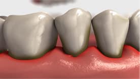 Example of periodontitis (stage 3 gingivitis).