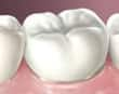 porcelain crown - colgate in