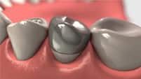 Porcelain fused to metal crowns