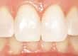 Teeth after tooth whitening bonding to repair the chipped tooth