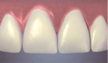 Tooth after bonding to repair the chipped tooth