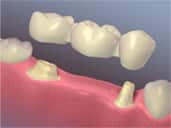 traditional dental bridge - colgate ph