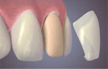 tooth veneers - colgate ph