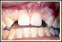 SingleToothImplants1