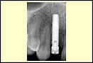 SingleToothImplants2