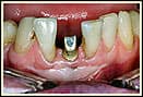 SingleToothImplants3