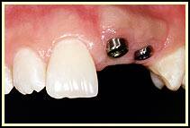 SingleToothImplants6