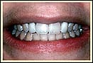 SingleToothImplants7