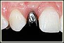 SingleToothImplants8