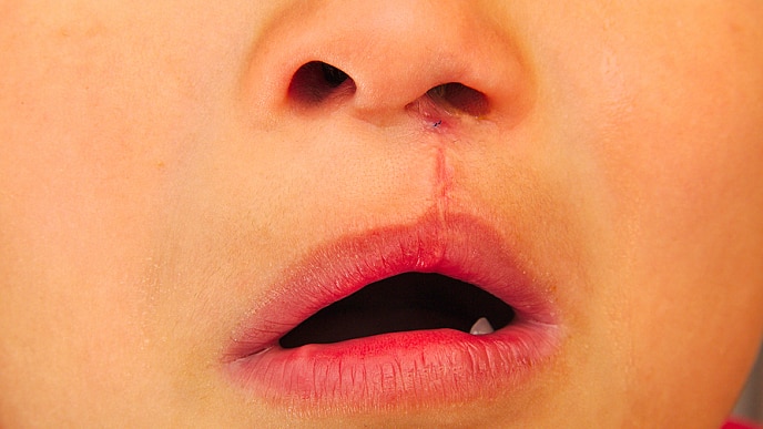 Boy showing an unilateral cleft lip repaired.