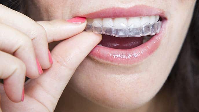 A close up of woman's mouth wearing clear braces