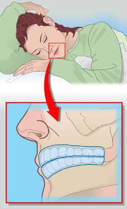 Aprieto los Dientes por la Noche ¿Tengo Bruxismo?