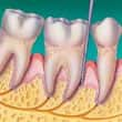 İleri Periodontitis