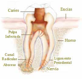 infección profunda