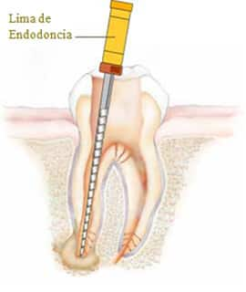 tejido infectado/inflamado