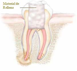 Reconstrucción del diente