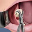 Para extraer el diente se utilizan fórceps dentales