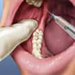 La zona alrededor del diente se anestesia antes de la extracción