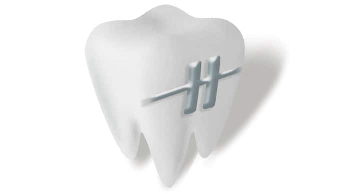 การดูแลรักษาสุขภาพฟันที่ดีขณะใส่อุปกรณ์จัดฟันการดูแลรักษาสุขภาพฟันที่ดีขณะใส่อุปกรณ์จัดฟัน
